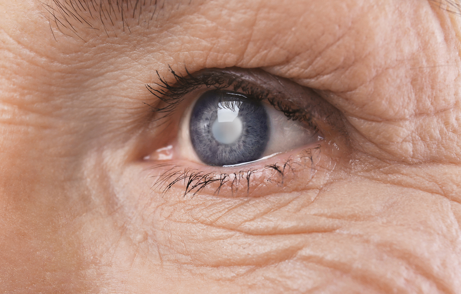 What is cataract?