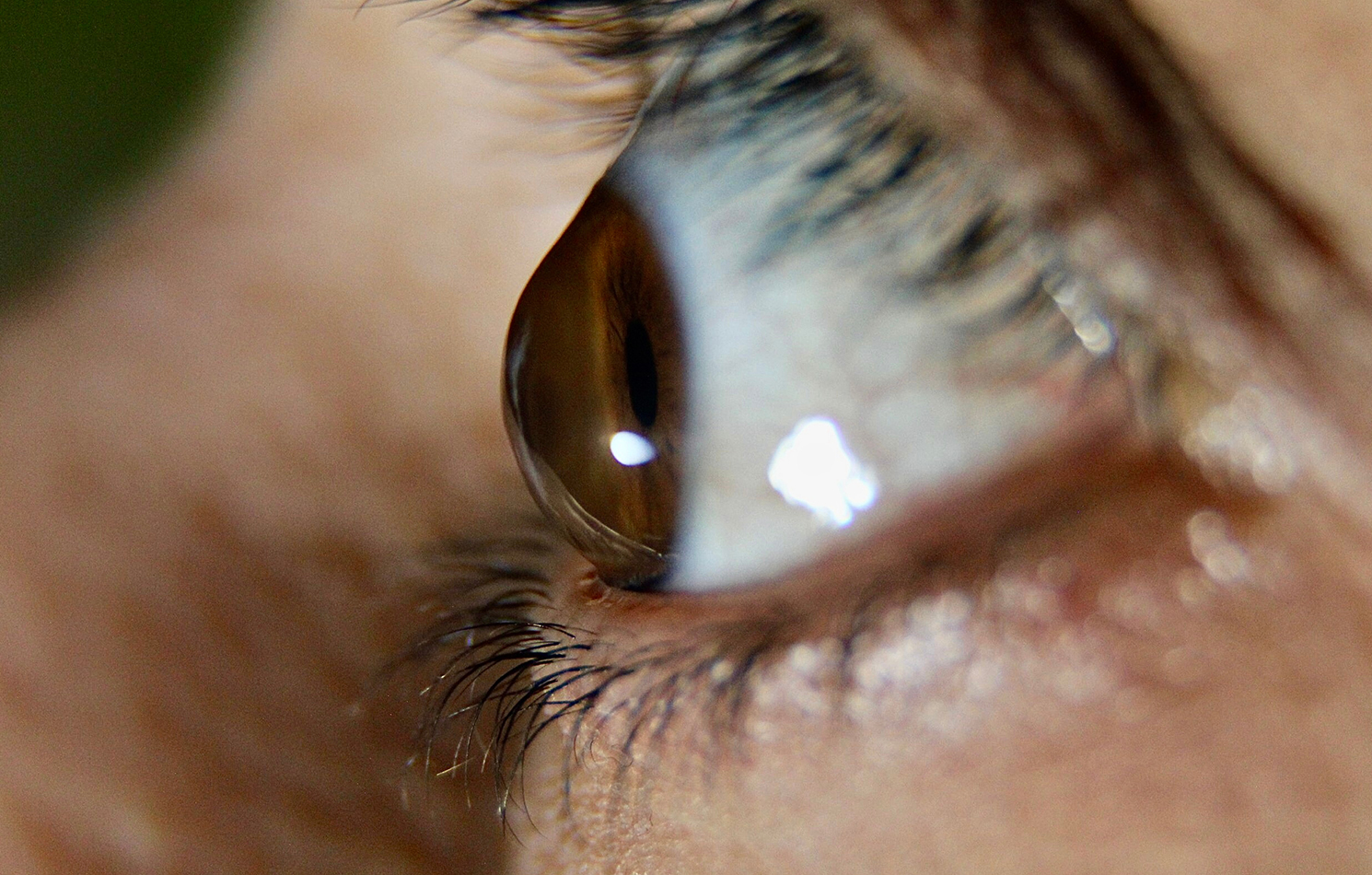 What is keratoconus?